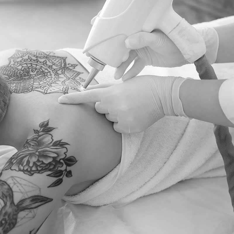 Painless Cream for Laser Tattoo Removal and treatments